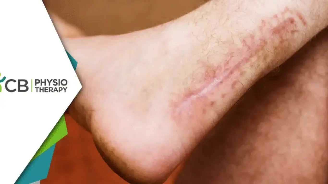 Achilles Tendon Rupture | Essential Role Of Postoperative Physiotherapy For Restoring Mobility