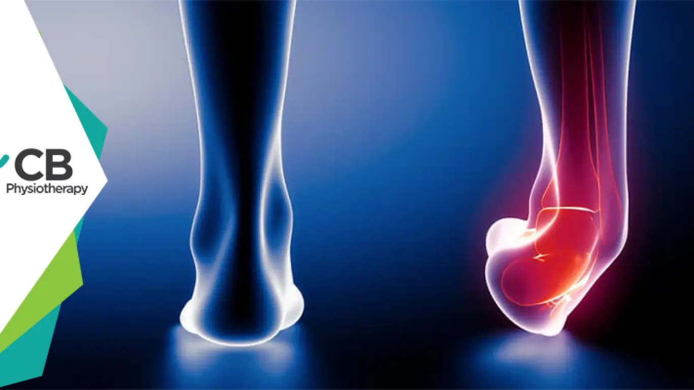 Ankle Sprain | Physiotherapy Management And Prevention.