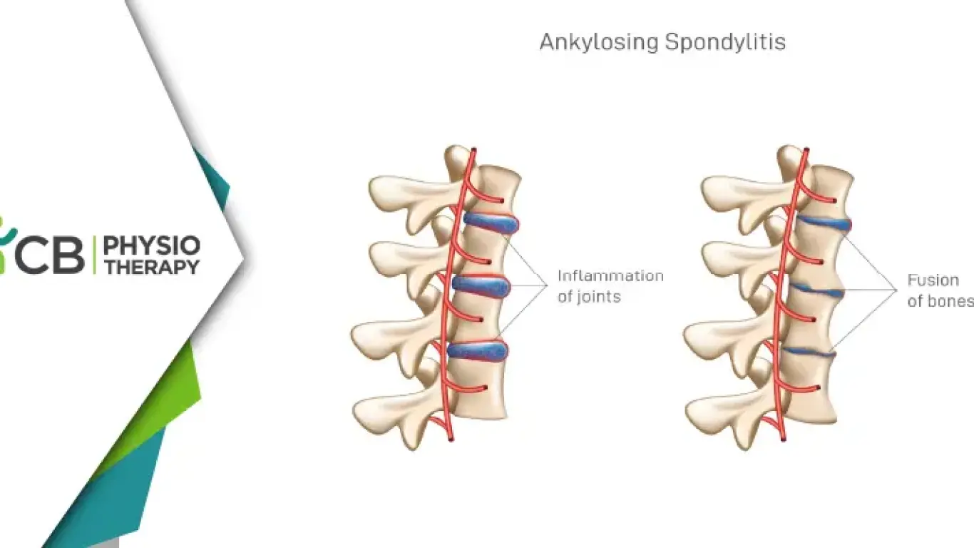 Ankylosing Spondylitis | How Physiotherapy Relieves Pain And Enhances Mobility?