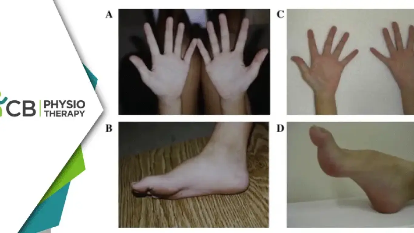 Charcot-marie-tooth Disease | The Essential Role Of Physiotherapy In Managing Cmt