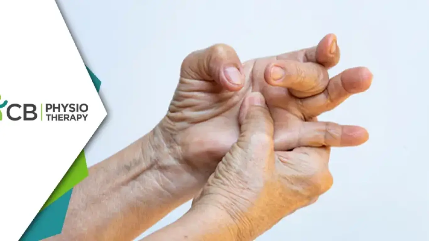 Easing The Grip | The Role Of Physiotherapy In Treating Trigger Finger