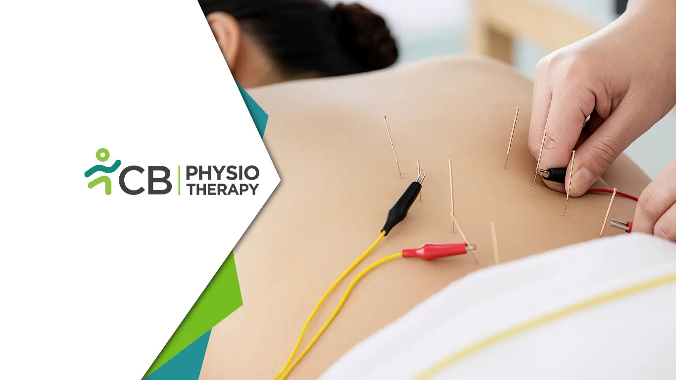 Electrical Dry Needling: Treat Muscle Pain & Restore Mobility — Cb Physiotherapy