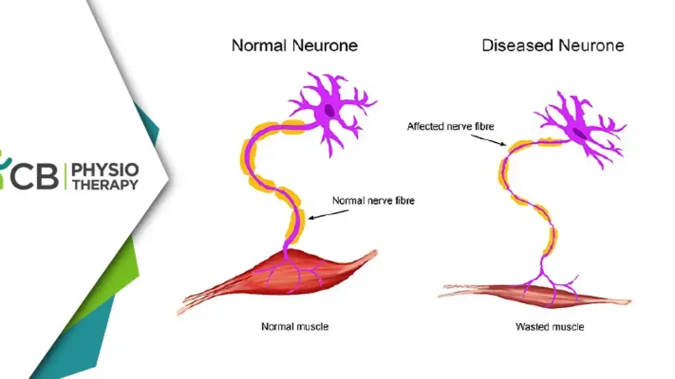 Empowering Lives | The Crucial Role Of Physiotherapy In Managing Motor Neuron Disease (mnd)