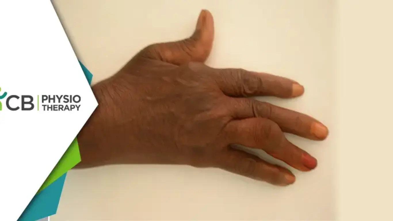 Exploring Rheumatoid Arthritis Deformities | Impact And Benefits Of Physiotherapy Treatment