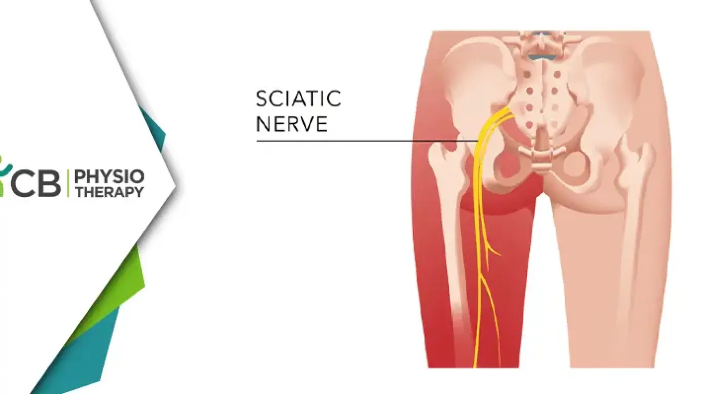 Find Relief From Sciatica In South Delhi | Experience Healing With Physiotherapy At Cb Physiotherapy