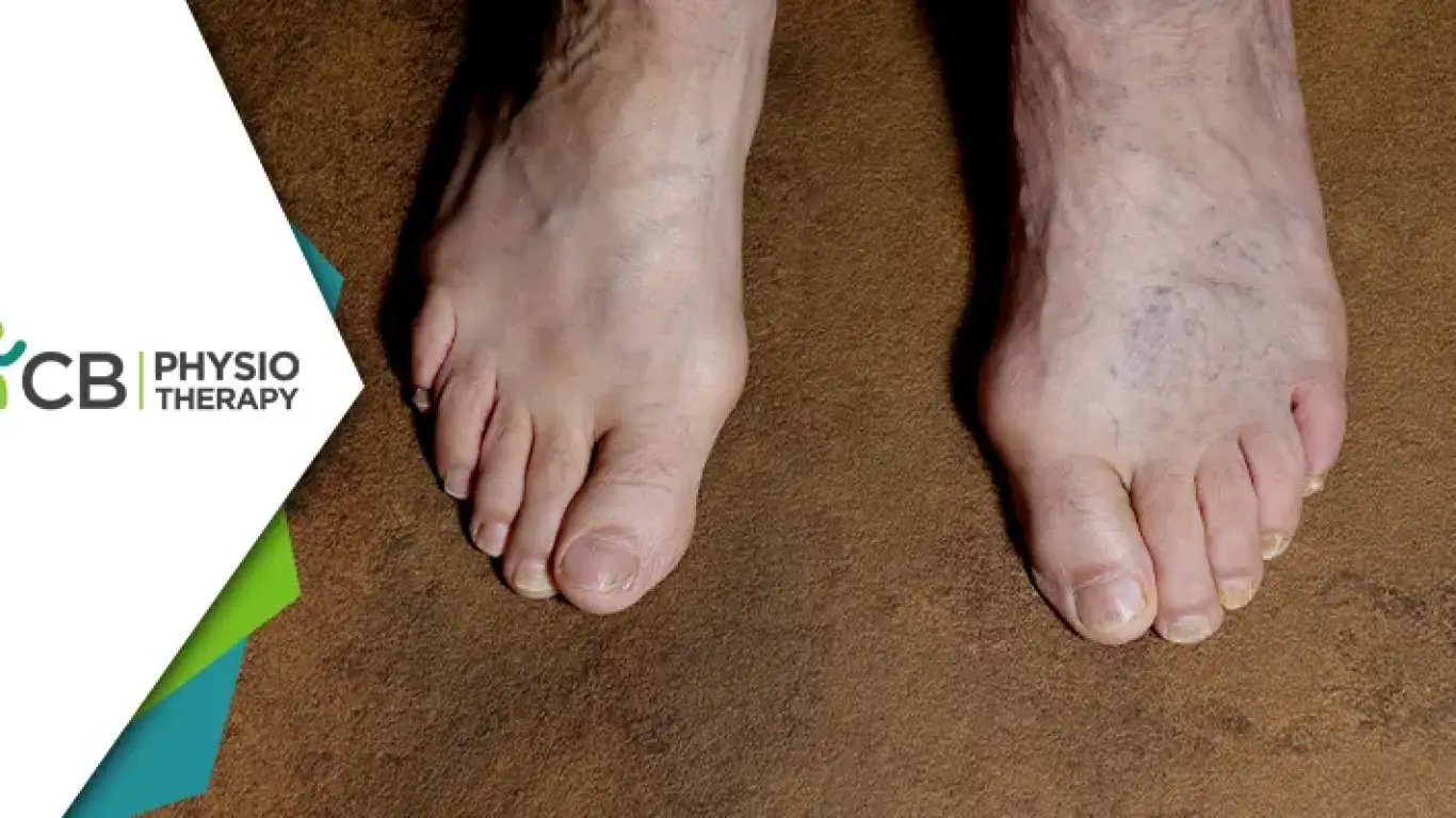 Gangrene Management | How Physiotherapy Plays A Vital Role In Recovery?