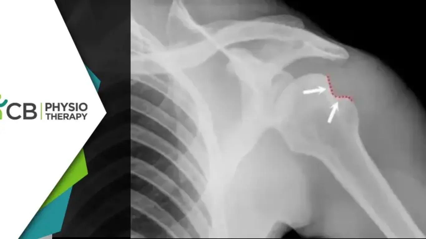Hill-sachs Lesion | How Physiotherapy Can Reduce The Risk Of Recurrent Shoulder Dislocations?