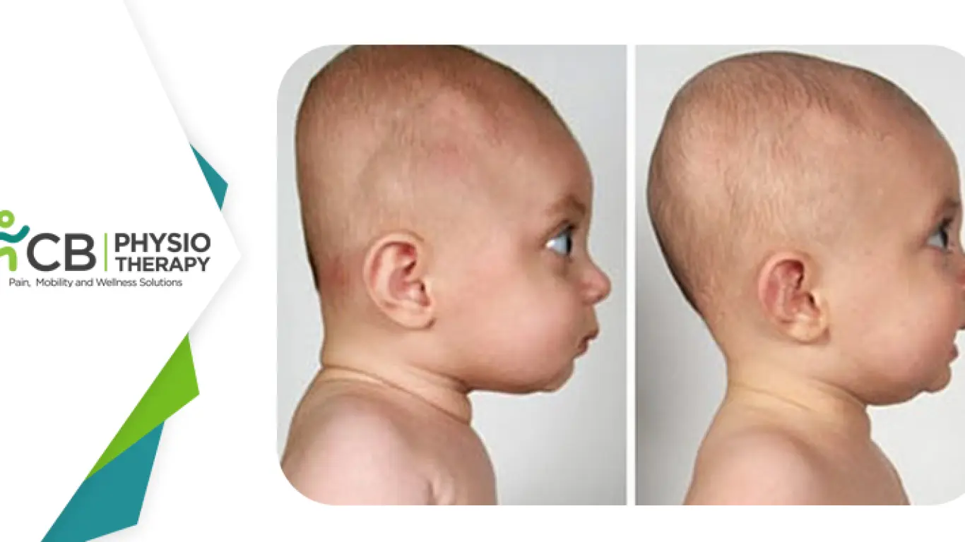 Infant Head Shape | How Physiotherapy Can Help Attain A Round Head?