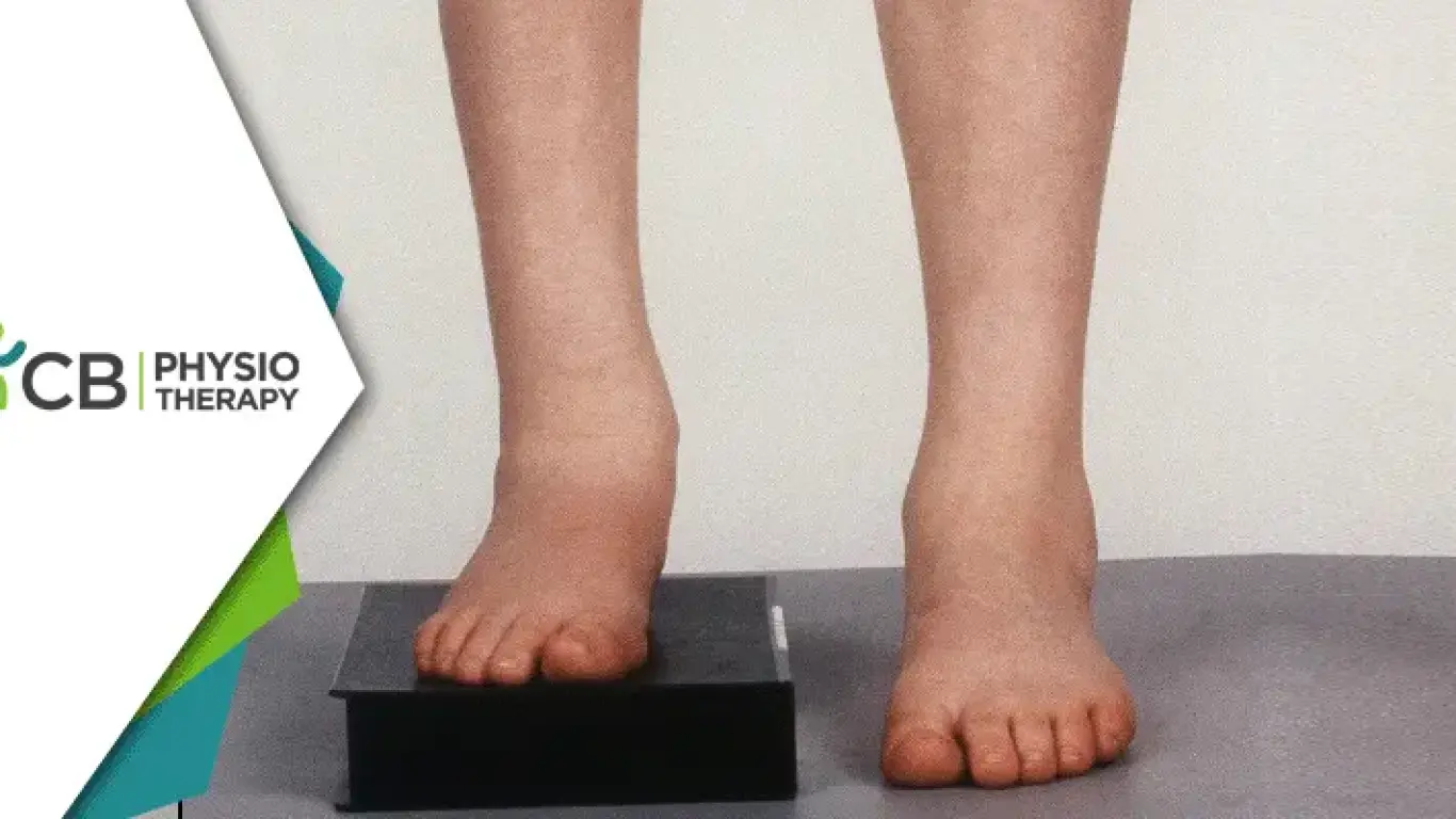Limb Length Discrepancy | Understanding Its Impact And The Role Of Physiotherapy In Management