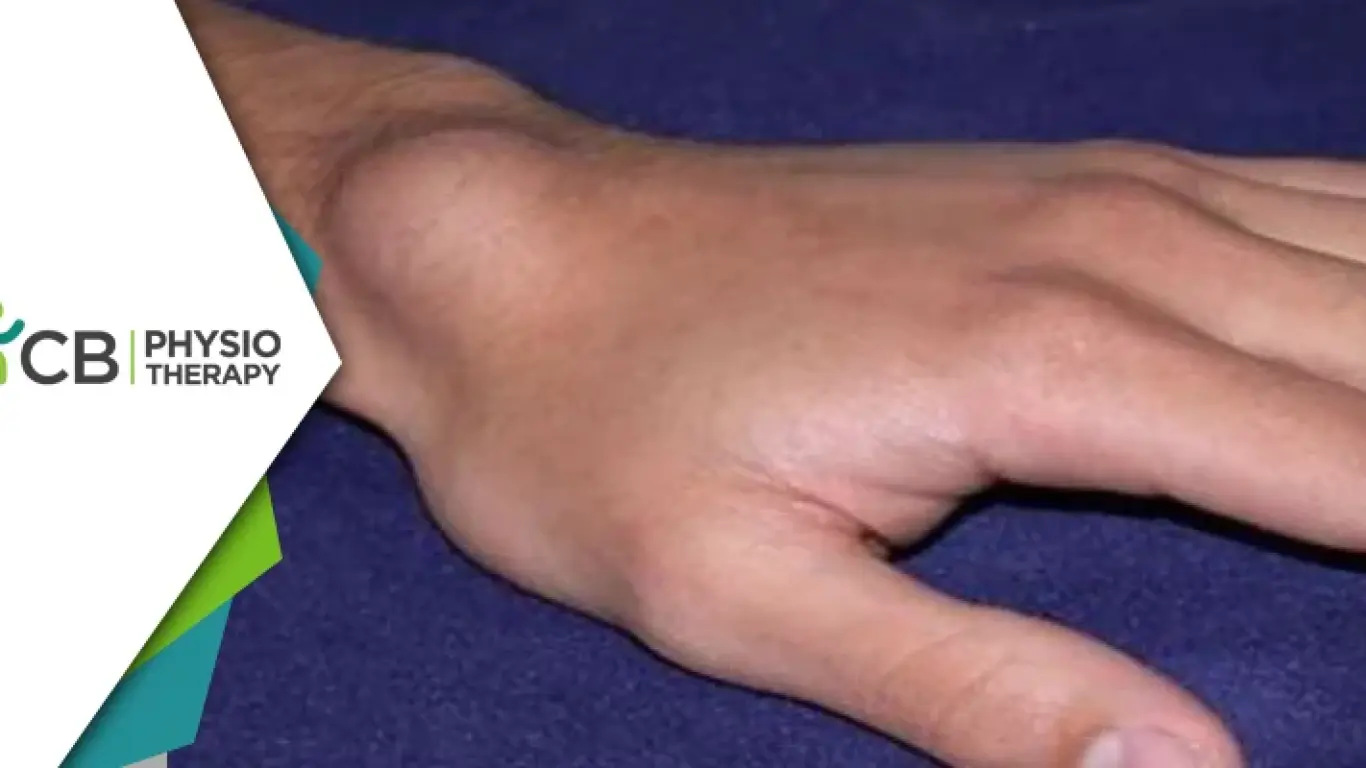 Managing Ganglion Cysts | Physiotherapy's Vital Role In Pain Relief And Function Improvement