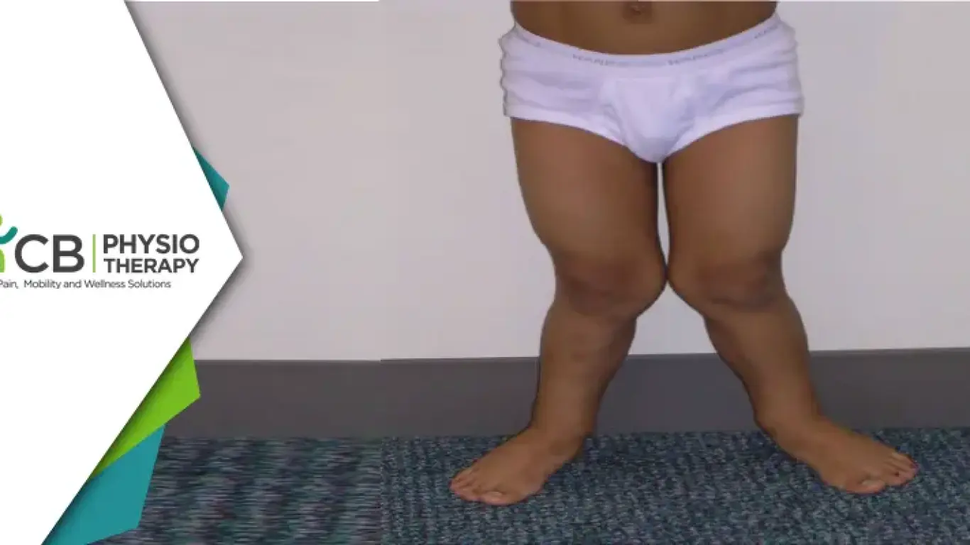 Managing Genu Valgus In Children | Strengthening And Stretching Of Stiff Muscles For Improved Growth