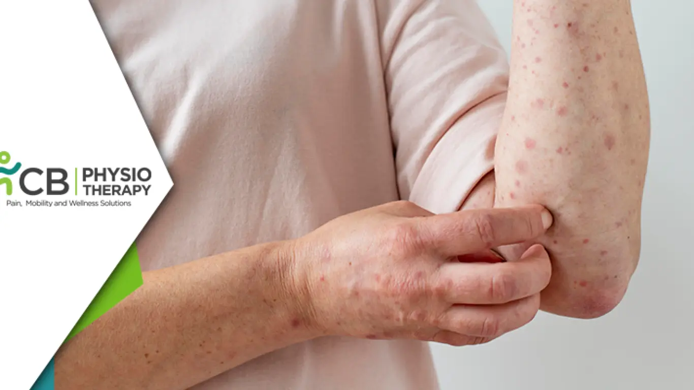 Physiotherapy In Leprosy | A Guide To Help People With Injury And Disability