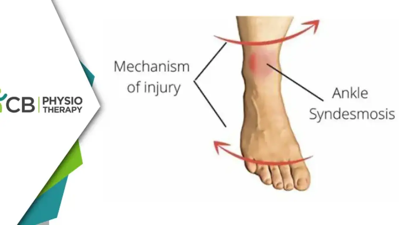Preventing And Managing High Ankle Sprains | Essential Physiotherapy Tips And Strategies