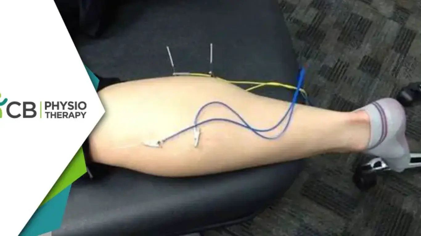Role Of Electrical Dry Needling In Physiotherapy | A Modern Approach To Pain Management And Recovery