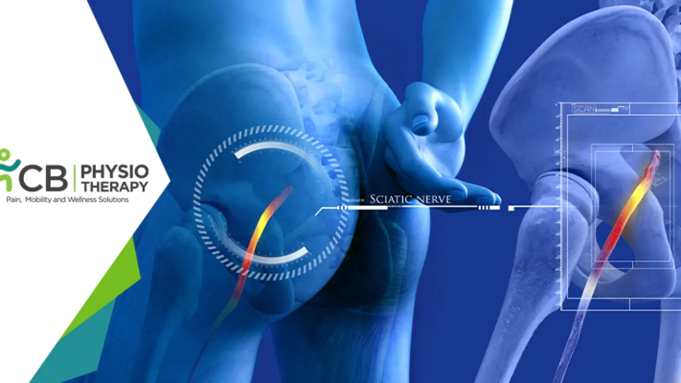 Sciatica | How Physiotherapy Management Helps In Relieving The Sciatic Nerve Pain?
