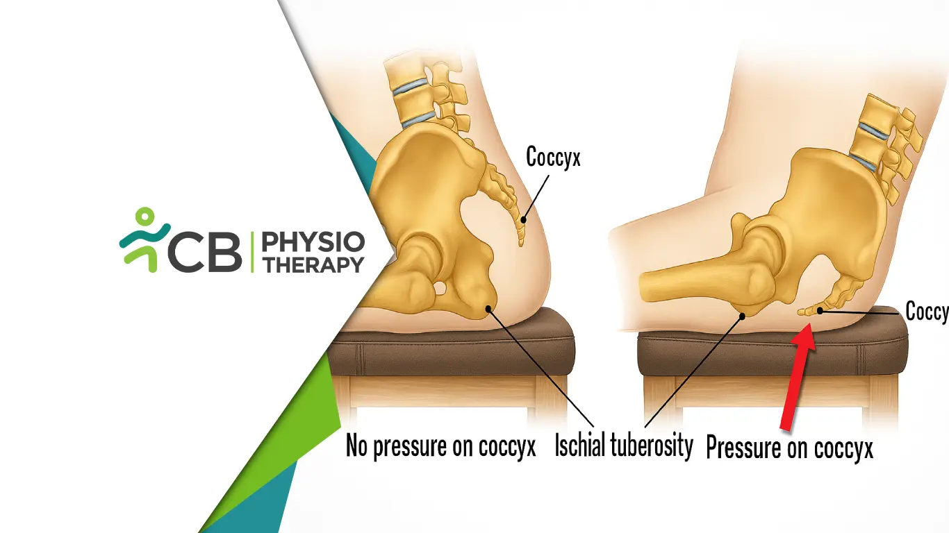 Tailbone Pain No More: Safe Approach For Treating Coccydynia At Cb Physiotherapy