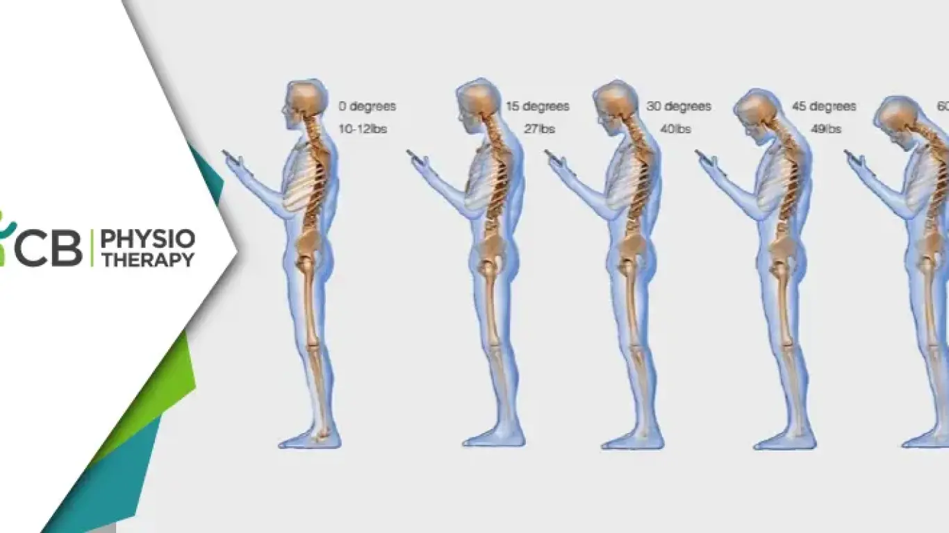 Text Neck Syndrome | How Physiotherapy Can Prevent And Treat This Modern-day Epidemic