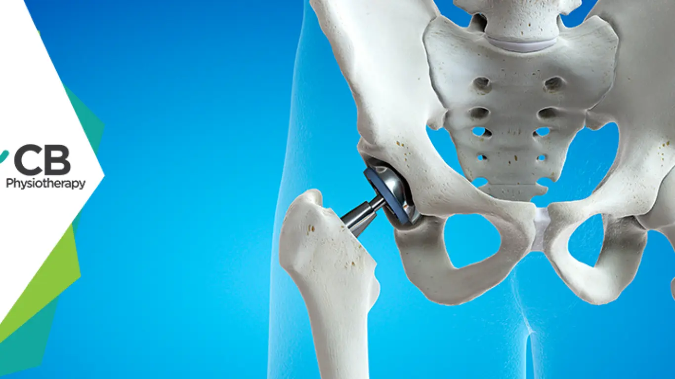 What Not To Do After Hip Replacement Surgery?