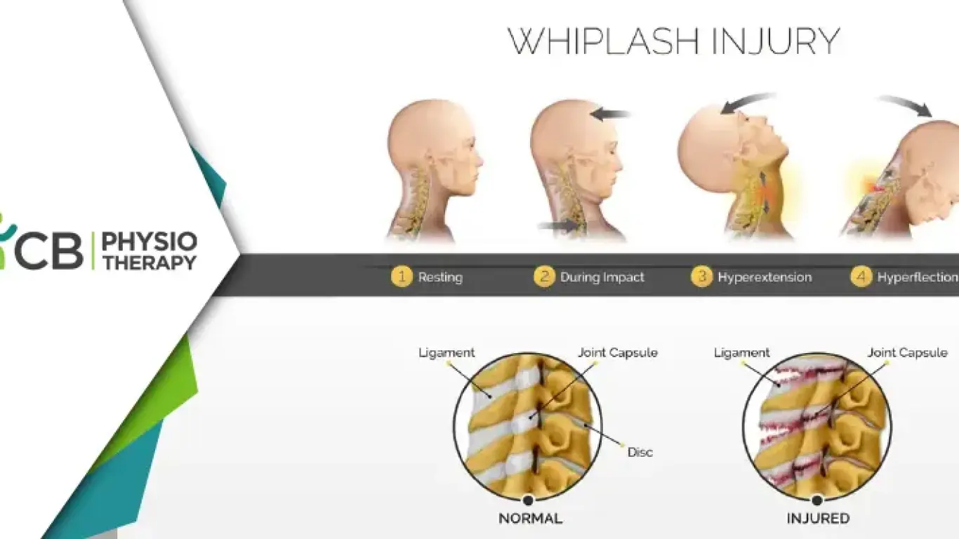 Whiplash Injury | How Physiotherapy Aids In Effective Treatment And Recovery