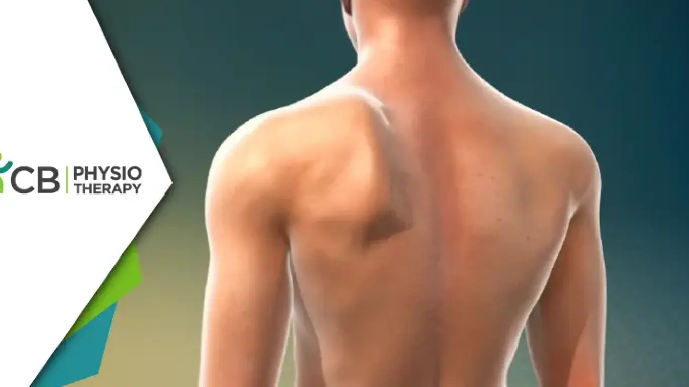 Winged Scapula | The Vital Role Of Physiotherapy In Effective Management