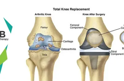 12 Best Postoperative Exercises For Knee Replacement