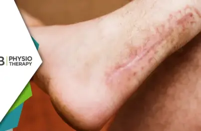 Achilles Tendon Rupture | Essential Role Of Postoperative Physiotherapy For Restoring Mobility