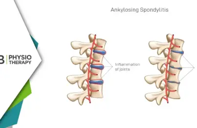 Ankylosing Spondylitis | How Physiotherapy Relieves Pain And Enhances Mobility?