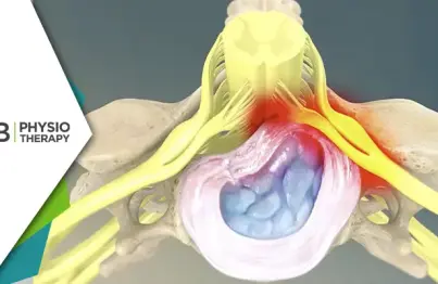 Cervical Myelopathy | How Physiotherapy Helps In Regaining Function And Control?