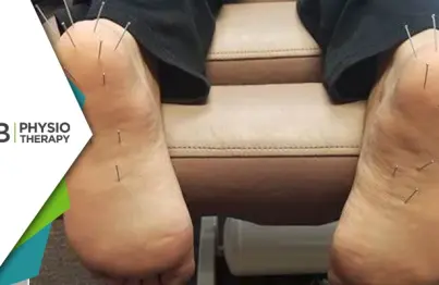 Dry Needling For Plantar Fasciitis | How It Can Help In The Management Of Heel Pain?