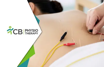 Electrical Dry Needling: Treat Muscle Pain & Restore Mobility — Cb Physiotherapy