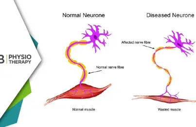 Empowering Lives | The Crucial Role Of Physiotherapy In Managing Motor Neuron Disease (mnd)