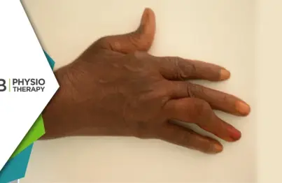 Exploring Rheumatoid Arthritis Deformities | Impact And Benefits Of Physiotherapy Treatment