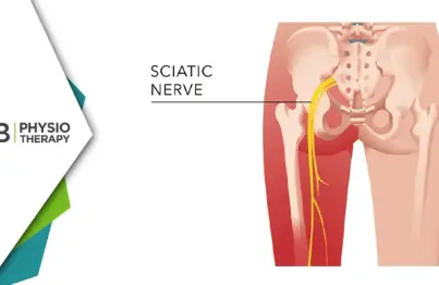 Find Relief From Sciatica In South Delhi | Experience Healing With Physiotherapy At Cb Physiotherapy