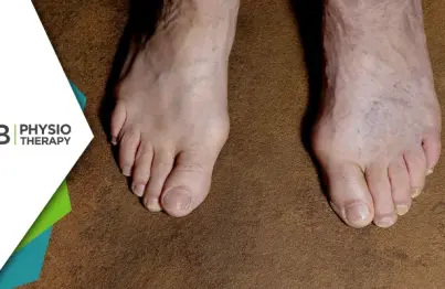 Gangrene Management | How Physiotherapy Plays A Vital Role In Recovery?