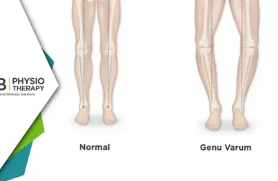 Genu Varum In Kids | A Physiotherapy Approach For Better Health.