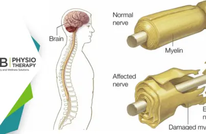 Guillain-barré Syndrome | Restoring Muscle Strength And Joint Functions By Physiotherapy