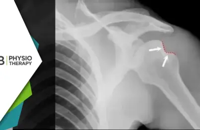 Hill-sachs Lesion | How Physiotherapy Can Reduce The Risk Of Recurrent Shoulder Dislocations?