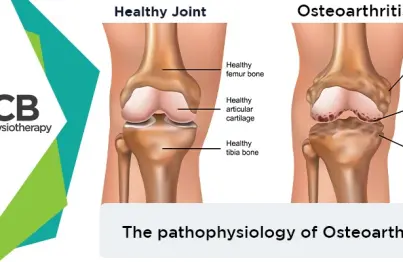 How Osteoarthritis Affects Our Body? Its Pathophysiology