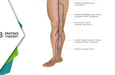 Intermittent Claudication | The Role Of Physiotherapy In Managing Peripheral Artery Disease