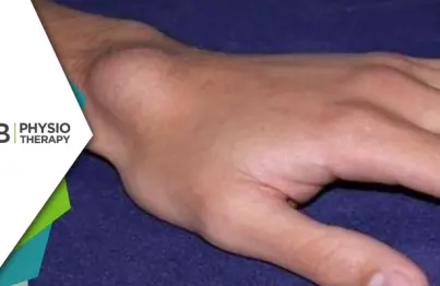 Managing Ganglion Cysts | Physiotherapy's Vital Role In Pain Relief And Function Improvement