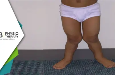 Managing Genu Valgus In Children | Strengthening And Stretching Of Stiff Muscles For Improved Growth