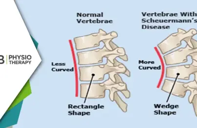 Managing Scheuermann's Disease | How Physiotherapy Can Improve Spine Health And Posture?