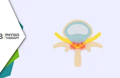 Neurogenic Claudication | Role Of Physiotherapy In Easing Pain, Enhancing Mobility, And Elevating Quality Of Life