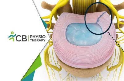 Recover From Back Pain | How To Heal An Annular Tear Without Surgery By Physiotherapy