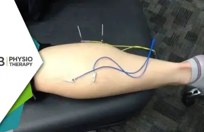 Role Of Electrical Dry Needling In Physiotherapy | A Modern Approach To Pain Management And Recovery