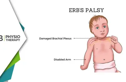 Role Of Electrical Stimulation In Managing Erb's Palsy | Enhancing Recovery And Functionality