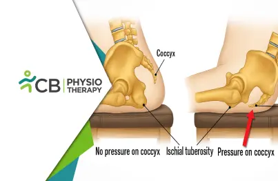 Tailbone Pain No More: Safe Approach For Treating Coccydynia At Cb Physiotherapy