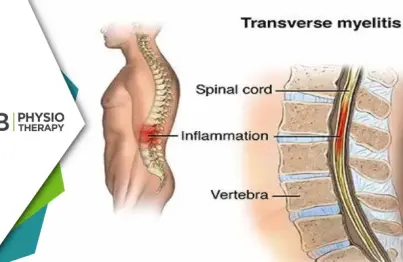 Transverse Myelitis | Managing Muscle Weakness And Regaining Mobility Through Physiotherapy