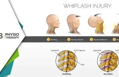 Whiplash Injury | How Physiotherapy Aids In Effective Treatment And Recovery