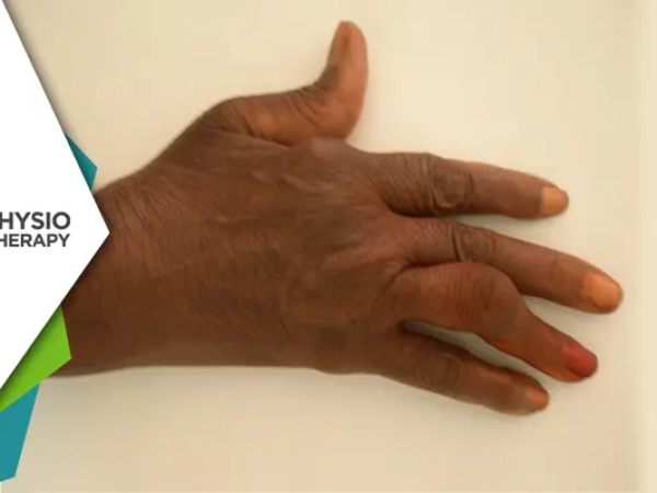 Exploring Rheumatoid Arthritis Deformities | Impact and Benefits of ...
